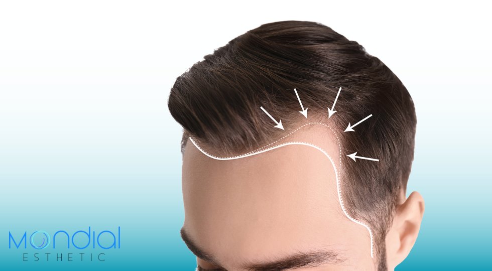 Hair Transplantation